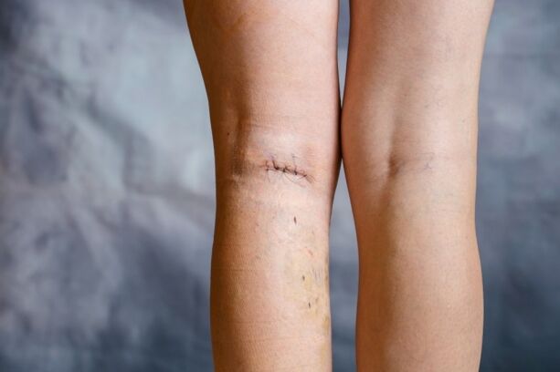Ράψιμο στο πόδι μετά από χειρουργική επέμβαση για κιρσούς