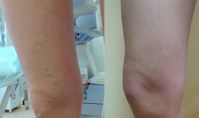 Πόδι πριν και μετά τη θεραπεία των κιρσών